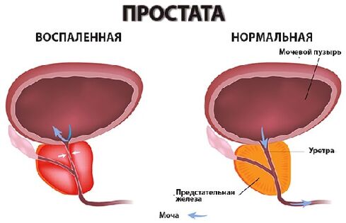 prosztata